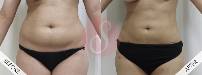 Best Liposuction Surgeon in Gurgaon - Liposuction Surgery Cost in